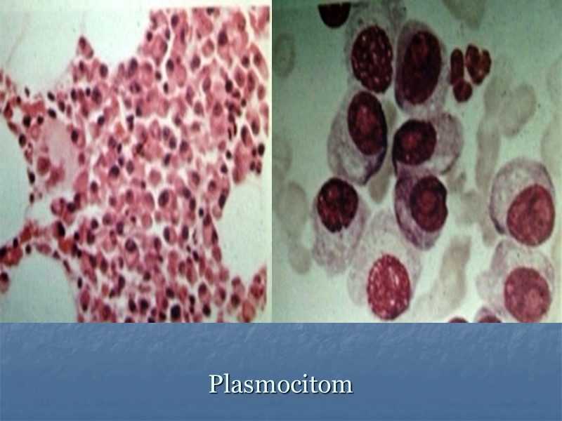 Plasmocitom